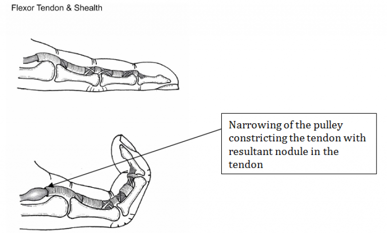How trigger finger is caused. Image source: Hand Surgery Associates