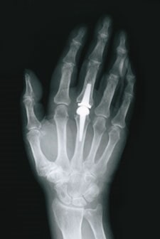 Implant Arthroplasty - X Rays