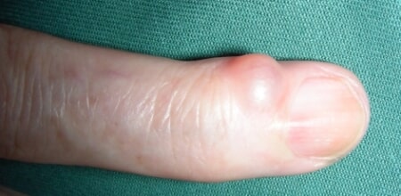 Mucous cyst of theDIPJ causing nail deformity | Hand ...