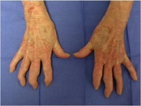 OA Hands Clinical Photo
