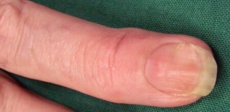 Post excision. Nail deformity will resolve with time after joint debridement and cyst excision