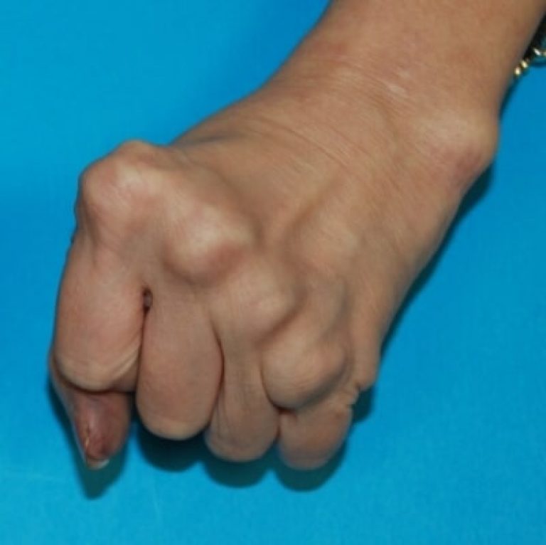 Deformitas Tangan Hand Surgery Associates deformitas-tangan-hand-surgery-associates