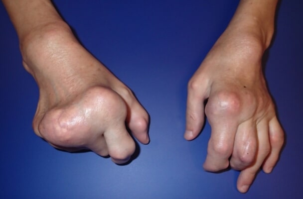 What are the causes of and treatments for deformed fingers?