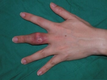 Gouty tophus affecting finger joints