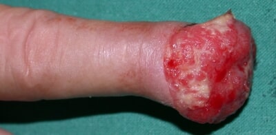 Kanker kulit pada ujung jari