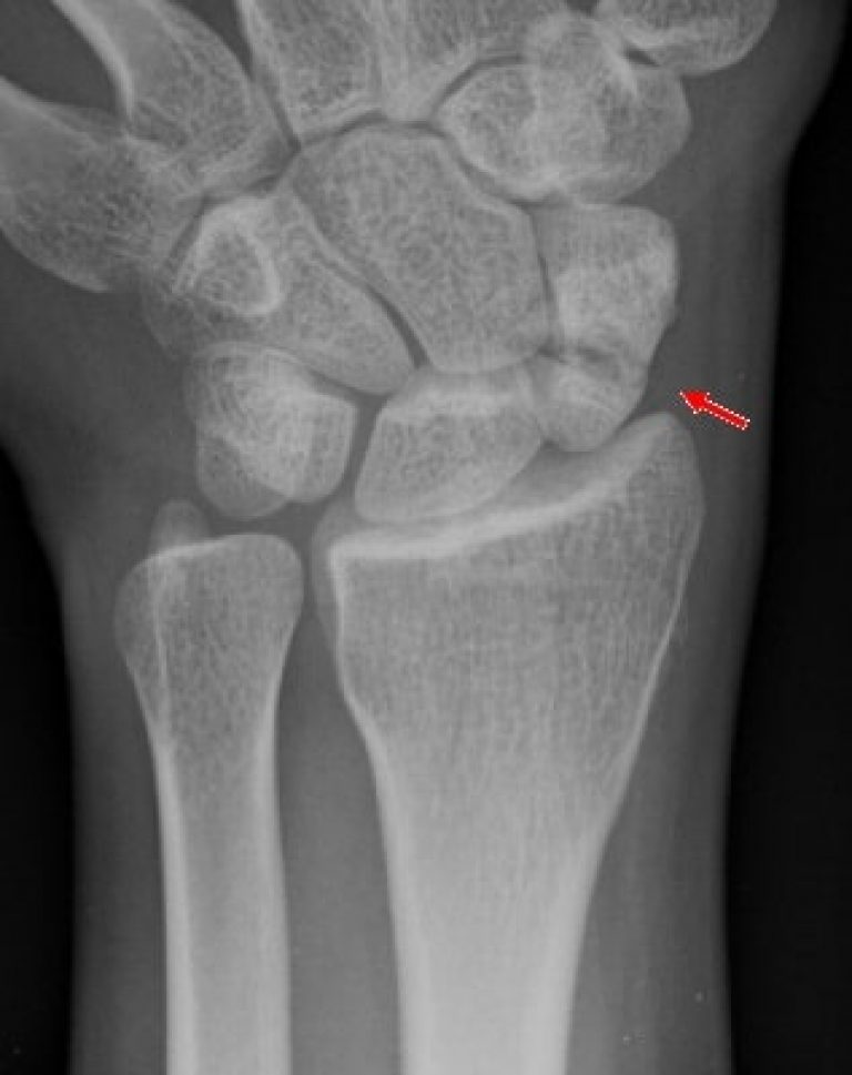 Hand Wrist Pain Treatment Hand Surgery Associates