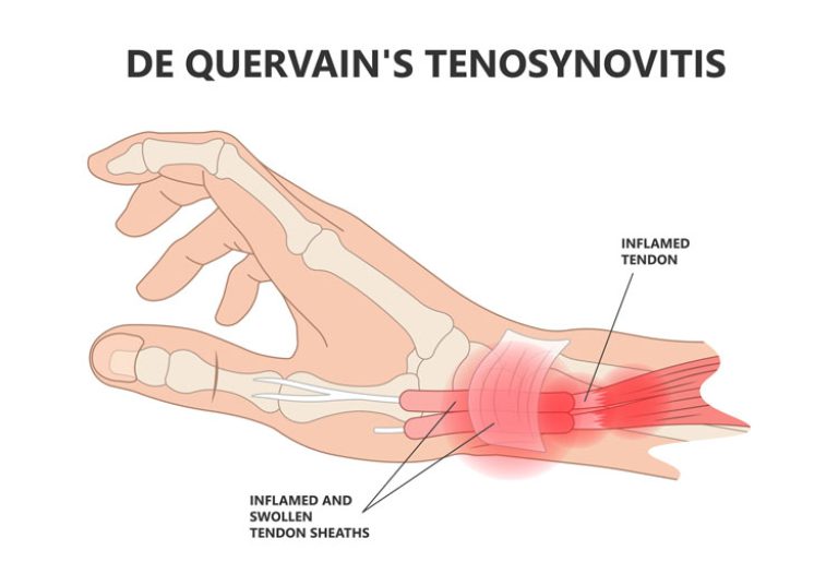 DeQuervain’s Tenosynovitis Treatment & Surgery in Singapore
